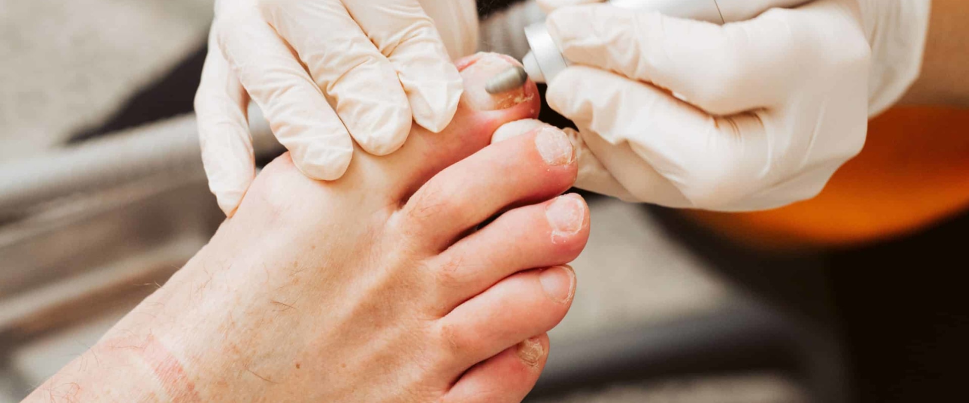 Expert Tips for Dealing with Thick Toenails