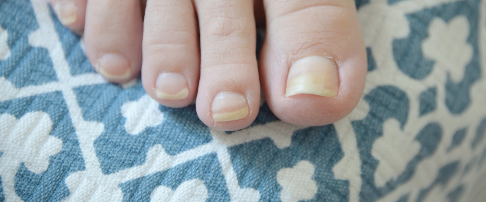 Expert Tips for Treating Thick Toenails