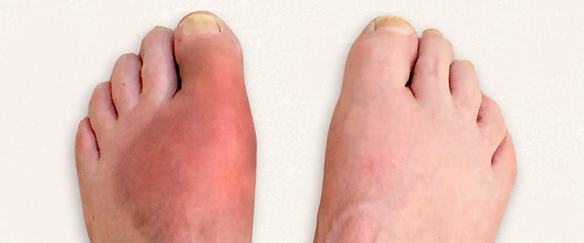 Expert Insights: Understanding Foot Diseases and Their Impact on Your Health