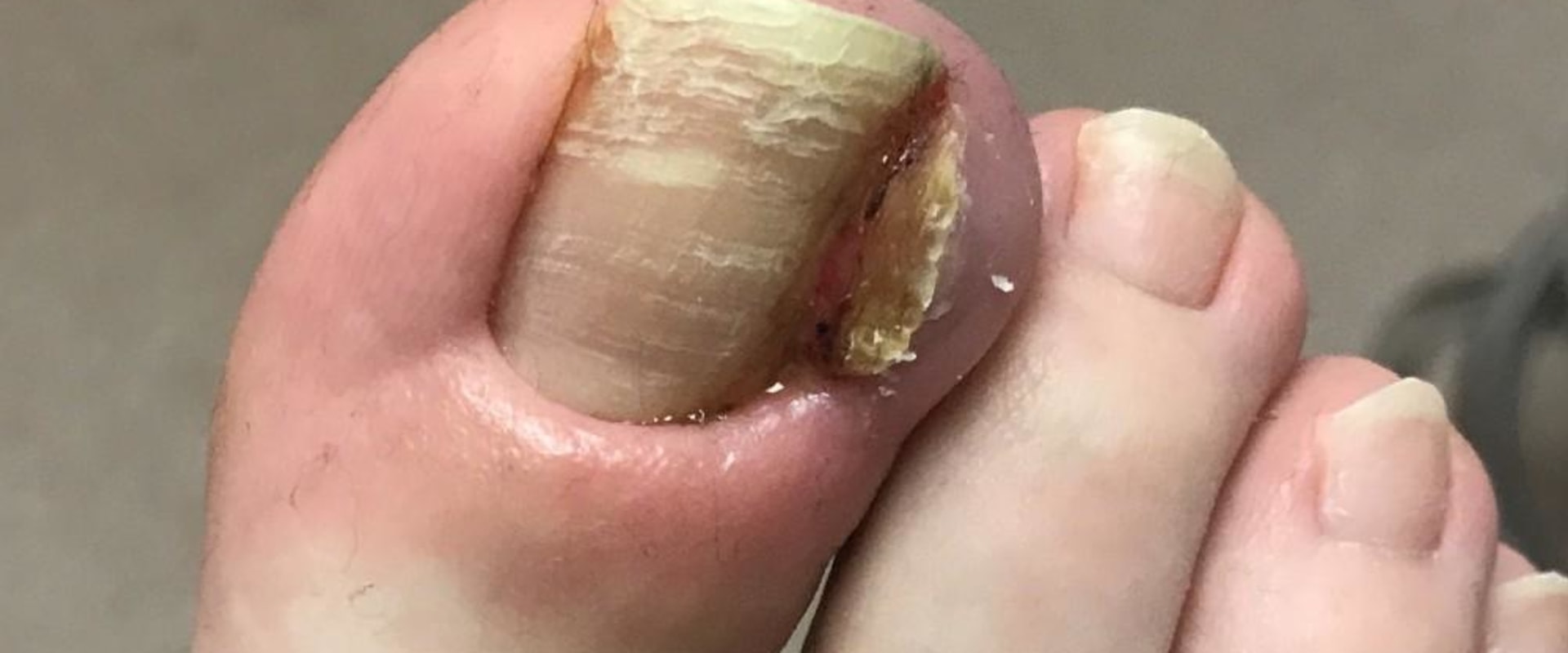 The True Cost of Toenail Cutting: What You Need to Know