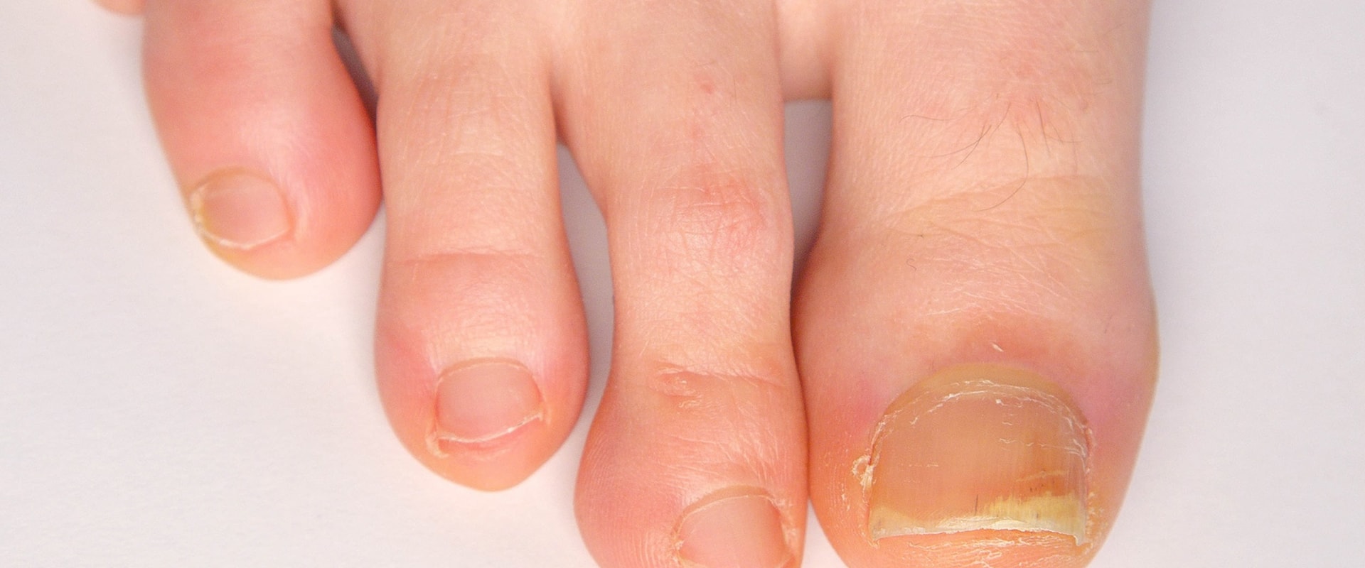 Expert Tips for Cutting Thick Toenails: How to Keep Your Feet Healthy