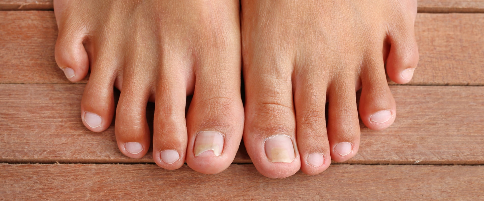 Why You Should See a Podiatrist for Your Toenail Care