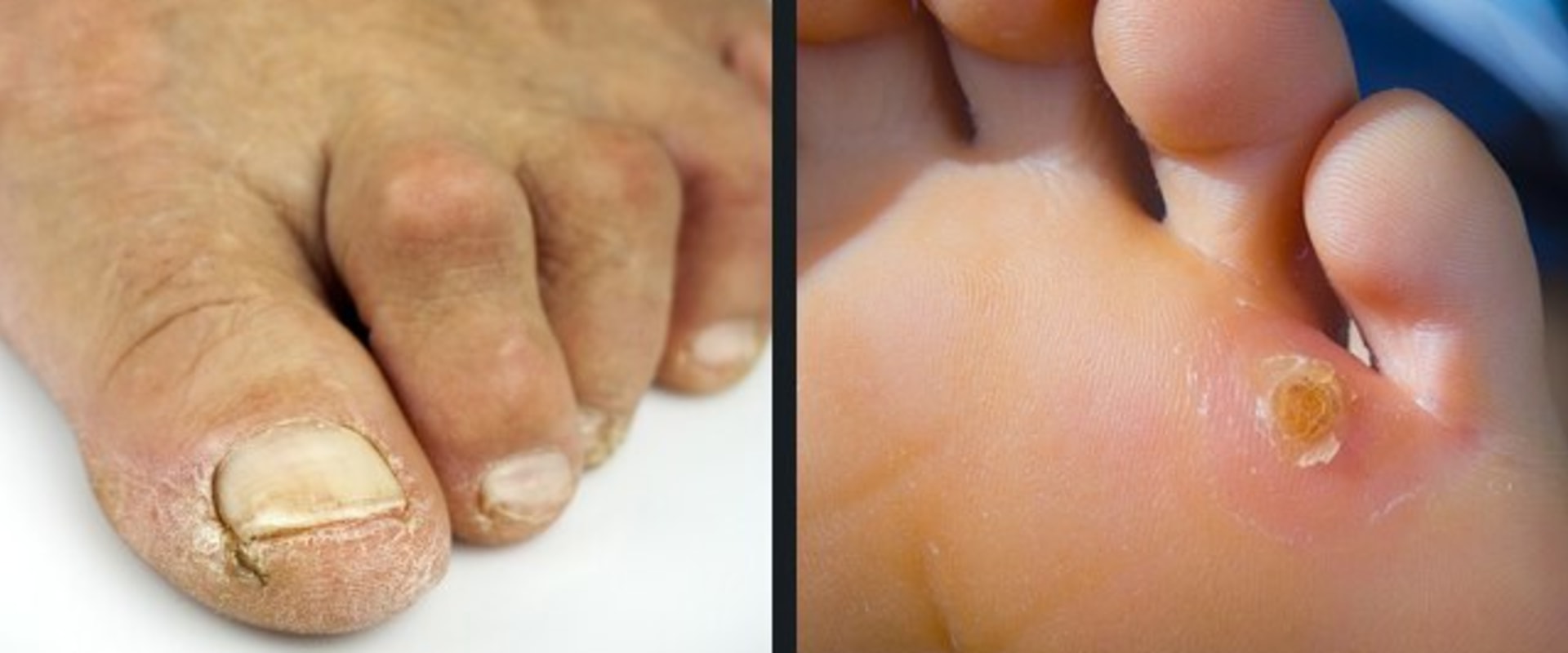 Expert Tips for Managing and Preventing Common Foot Disorders