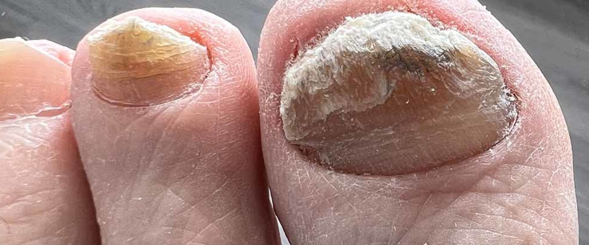 Expert Tips for Managing Thick Toenails