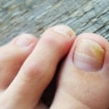 Expert Advice: Choosing Between a Dermatologist and Podiatrist for Toenail Fungus Treatment