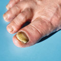 Expert Insights: Understanding and Treating Thickened Toenails