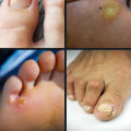 Expert Tips for Managing and Preventing Common Foot Disorders