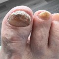 Expert Tips for Managing Thick Toenails