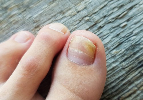 Expert Advice: Choosing Between a Dermatologist and Podiatrist for Toenail Fungus Treatment