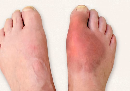 Expert Insights: Understanding Foot Diseases and Their Impact on Your Health