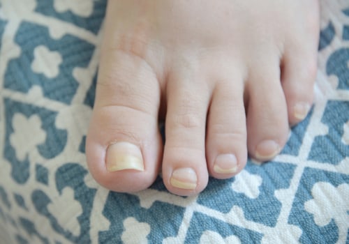 Expert Tips for Dealing with Thick Toenails