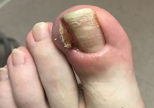 The True Cost of Toenail Cutting: What You Need to Know