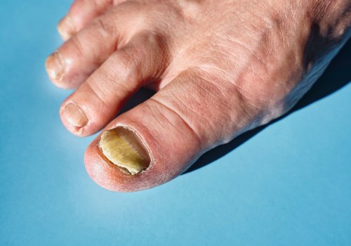 Expert Insights: Understanding and Treating Thickened Toenails