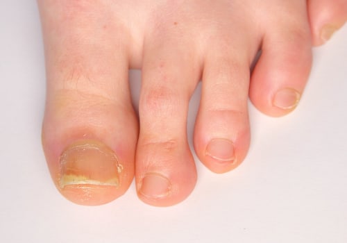 Expert Tips for Cutting Thick Toenails: How to Keep Your Feet Healthy