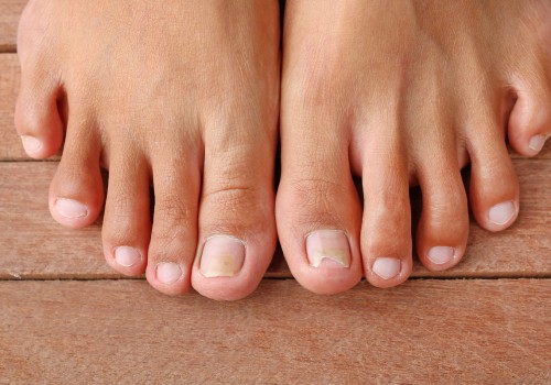 Why You Should See a Podiatrist for Your Toenail Care