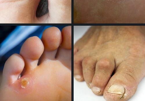 Expert Tips for Managing and Preventing Common Foot Disorders