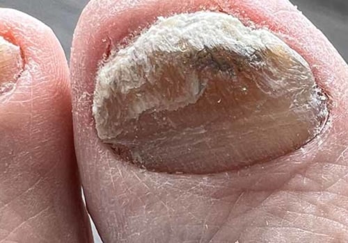 Expert Tips for Managing Thick Toenails